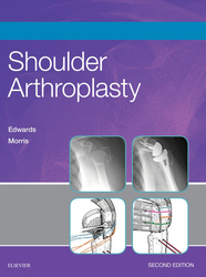 Shoulder Arthroplasty