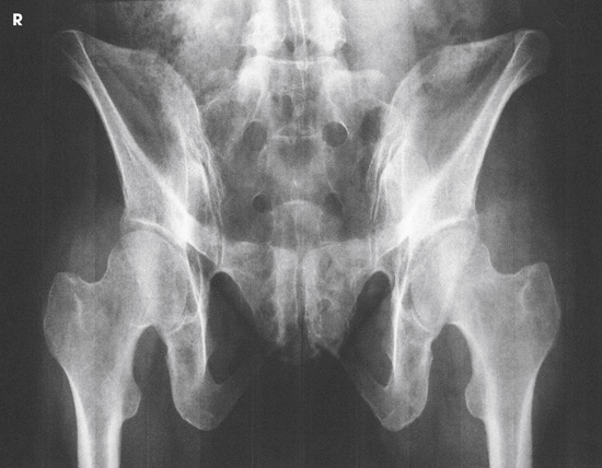 Pelvis and Hip