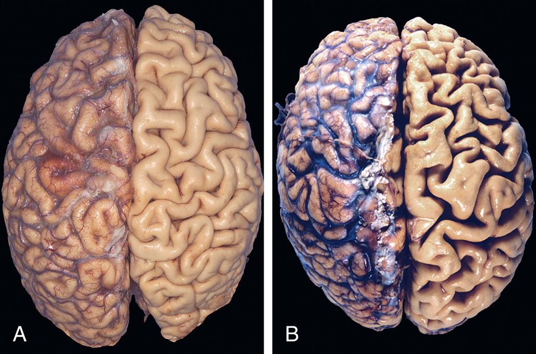 Photo A is the superior view of a young adult’s normal brain. Photo B is the superior view of an elderly male’s brain affected by atherosclerotic cerebrovascular disease.