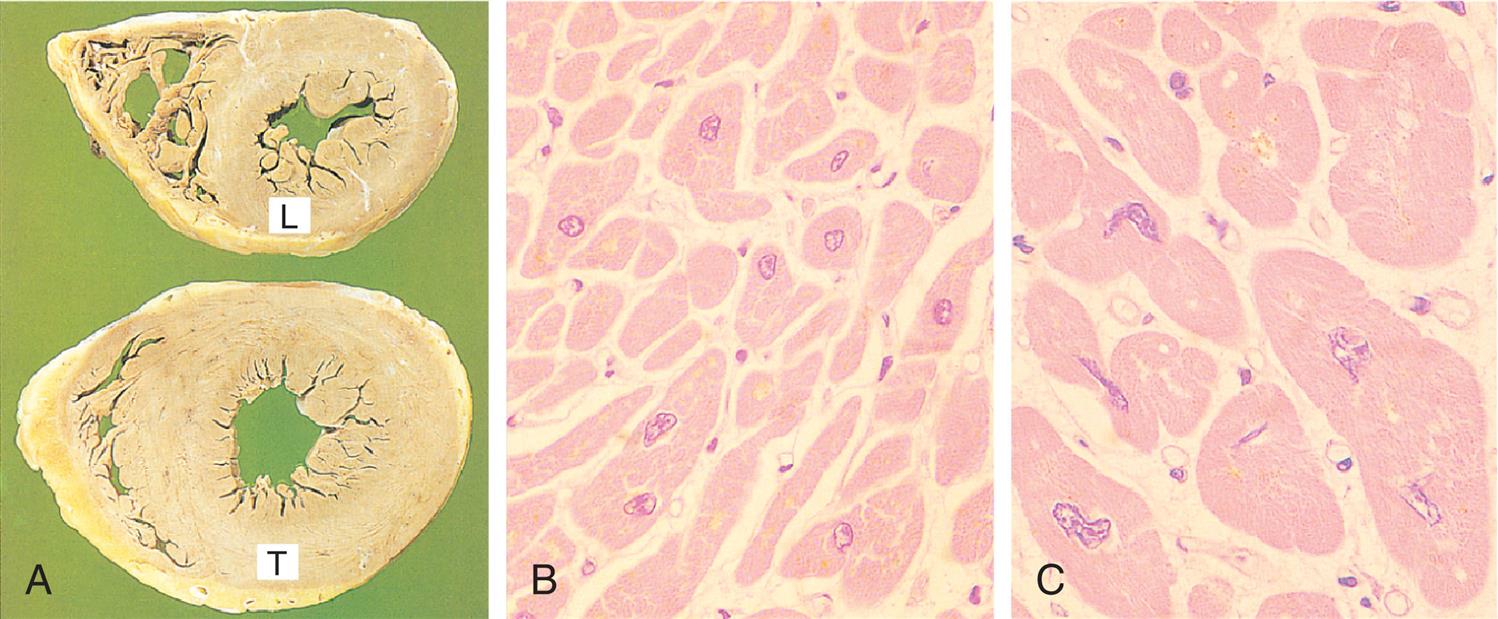 Close-up A shows transverse slices of a heart, one with normal thickness, labeled L, and the other with thickened walls, labeled T. Micrograph B shows normal tissues in the cardiac muscle of a heart. Micrograph C shows larger and thicker tissues in the cardiac muscle of a heart.