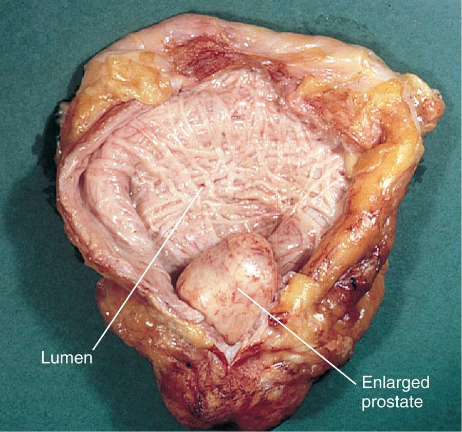 A close-up shows and labels the lumen and an enlarged prostate in a bladder.
