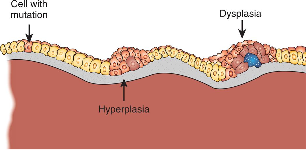 A diagram shows a series of cells with three distinct sections. The section on the left shows a mutated cell nestled between two normal cells. The section in the middle show a cluster of cells affected by hyperplasia. The section on the right shows a cluster of cells affected by dysplasia.