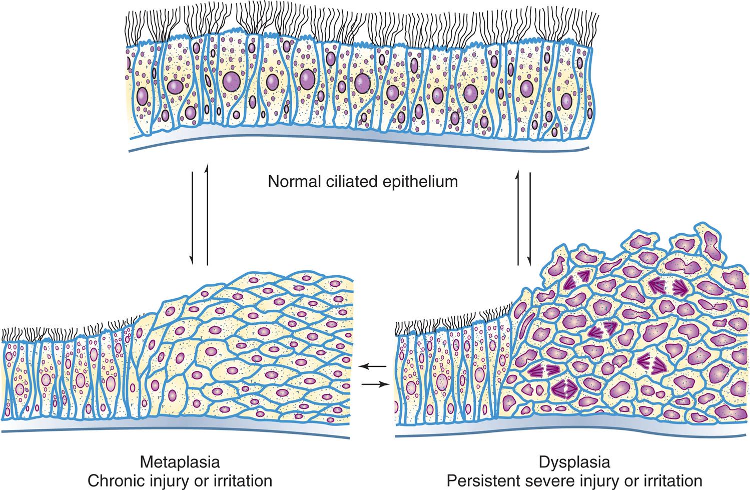 A three-part diagram illustrates reversible changes in cells along the lining of the bronchi. The part at the top shows a normal ciliated epithelium. The part on the bottom left shows epithelium cells with metaplasia, resulting in chronic injury or irritation. The part on the bottom right shows epithelium cells with dysplasia, resulting persistent severe injury irritation. Each part can experience a reversible process resulting in the other part.