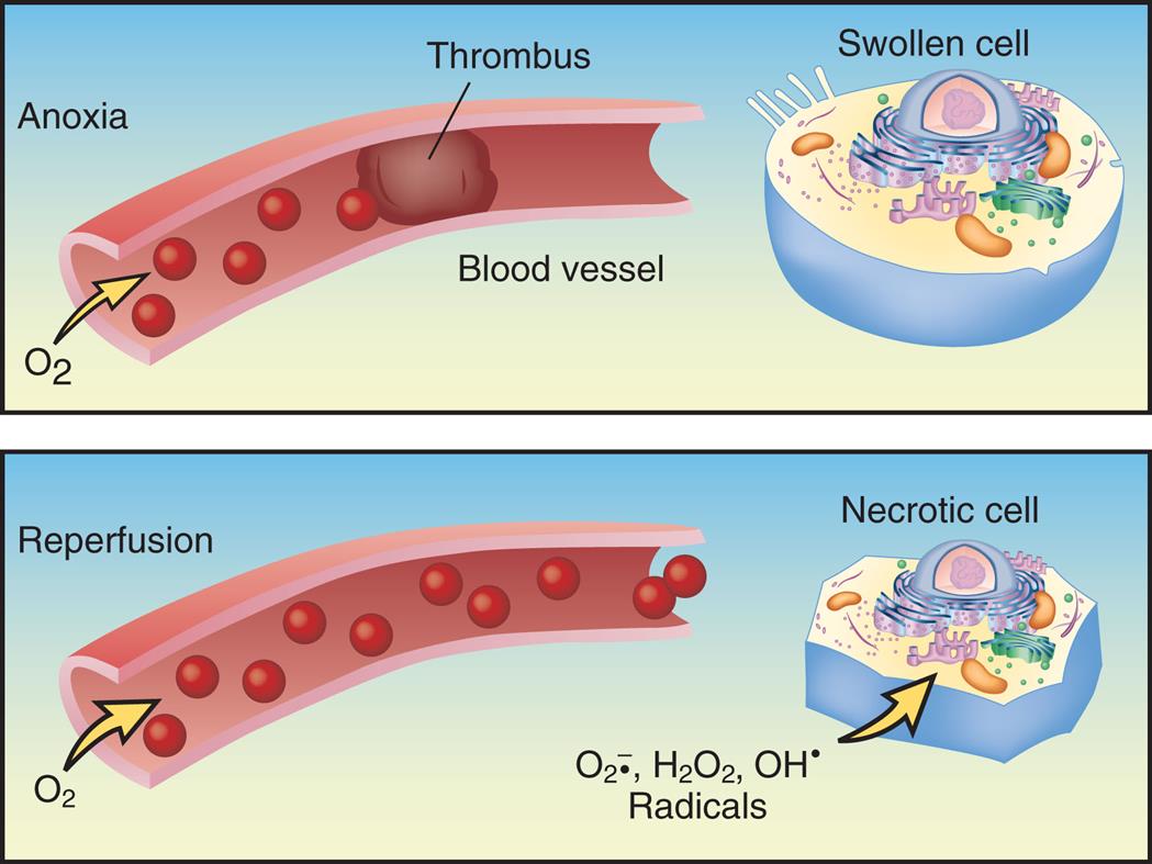 A two-part illustration demonstrates anoxia and reperfusion. The panel for anoxia, at the top, shows a thrombus blocking the passage of oxygen through the blood vessel. An accompanying cutaway diagram shows a swollen cell. The panel for reperfusion, at the bottom, shows oxygen flowing freely through the blood vessel. An accompanying cutaway diagram shows a necrotic cell with radicals: O 2 anions, H 2 O 2, and O H.