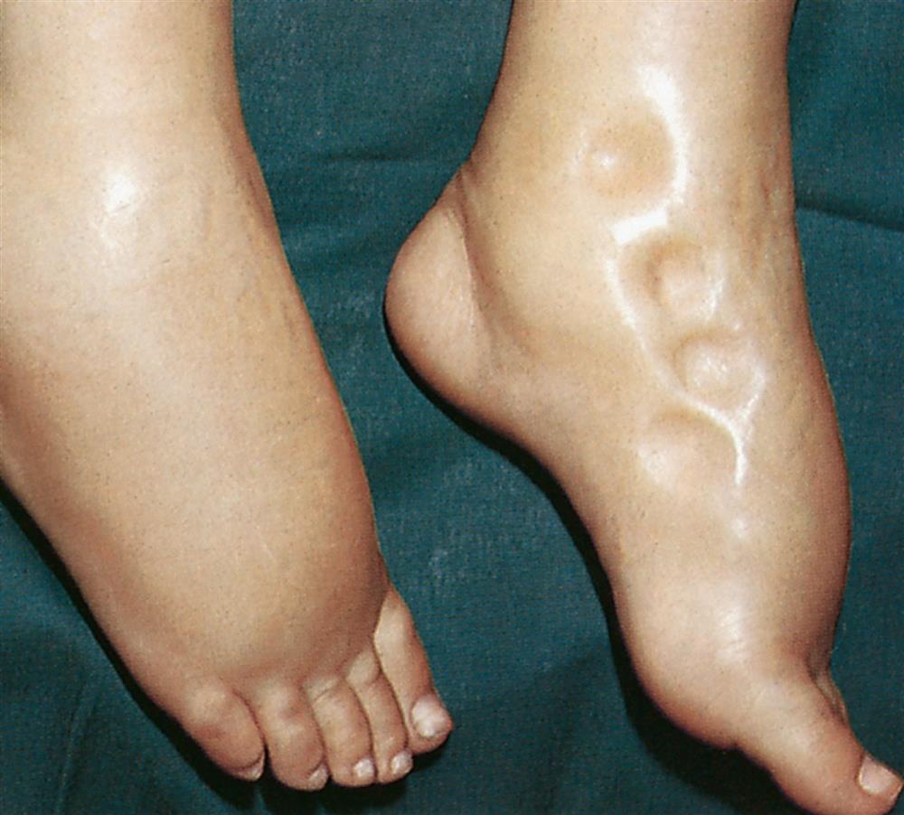 A close-up shows two heavily swollen feet. There are four distinctively large pits on the medial side of the left foot.