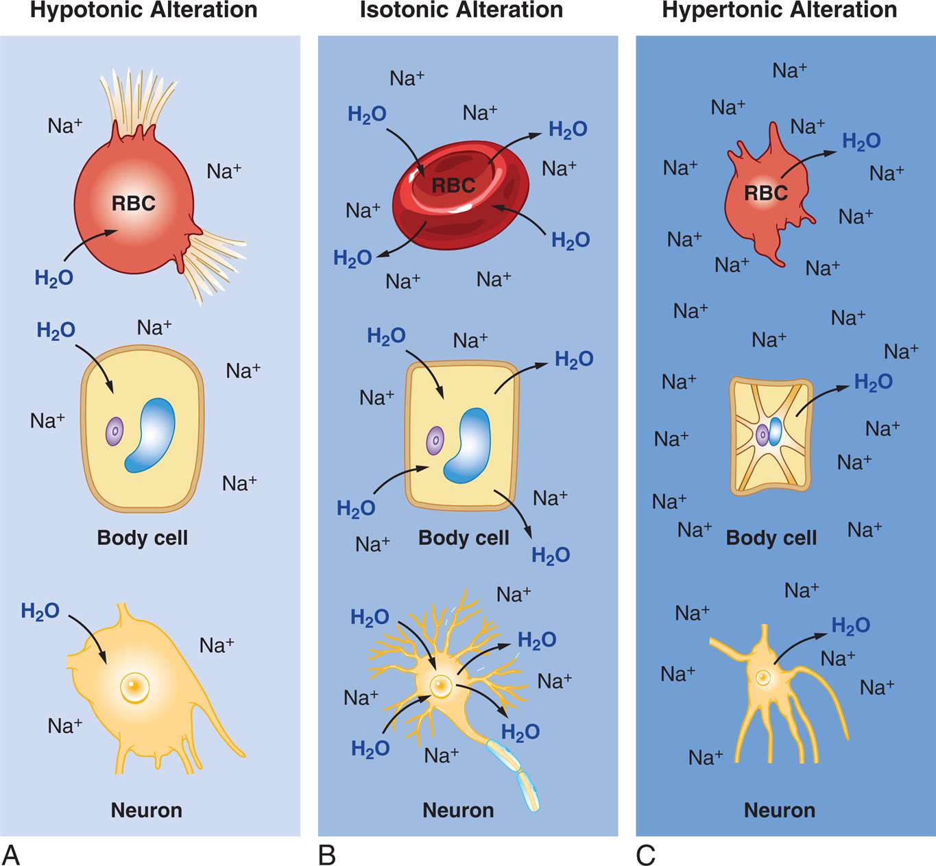 Three illustrations, A, B, and C, demonstrate the effects of hypotonic, isotonic, and hypertonic alterations, respectively, in R B C, body cell, and neuron. Illustration A, hypotonic alteration. When the concentration of sodium ions is less, the R B C, the body cell, and the neuron attract water, leading to swelling and or busting of the cells. Illustration B, isotonic alteration. When the concentration of sodium ions is normal, the osmolality of water in R B C, body cell, and neuron, is even. Illustration C, hypertonic alteration. When the concentration of sodium ions is high, the R B C, the body cell, and the neuron expel water, leading to shrinking of the cells.