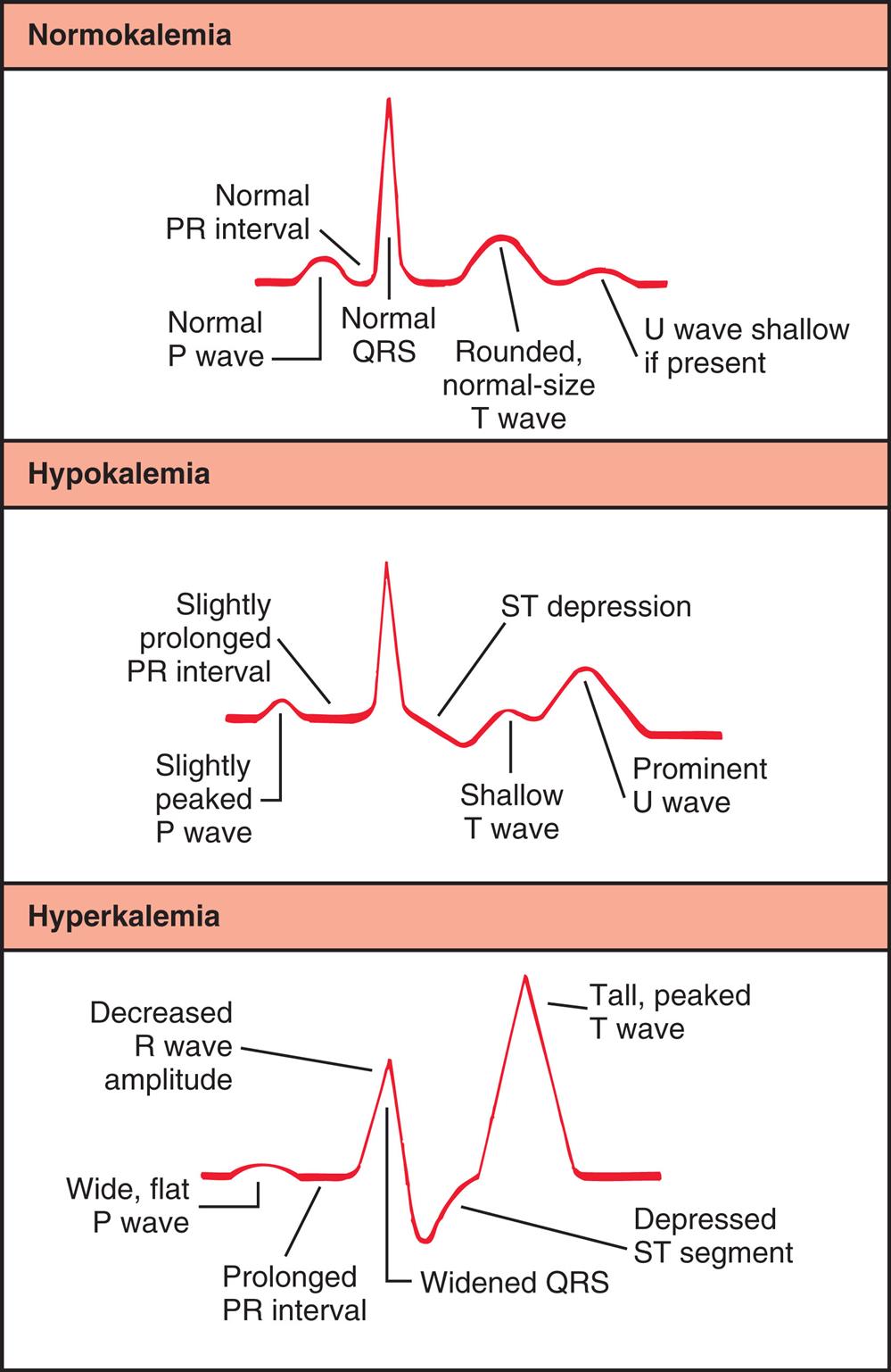 A three-panel illustration graphs tracing the electrocardiogram changes with potassium imbalance. Each graph traces waves, intervals, and peaks. Top panel, normokalaemia. The order of tracing, from the left to the right, is as follows: Normal P wave, normal P R interval, normal Q R S, rounded, normal-size T wave, and U wave shallow if present. Middle panel, hypokalemia. The order of tracing, from the left to the right, is as follows: slightly peaked P wave, slightly prolonged P R interval, S T depression, shallow T wave, and prominent U wave. Bottom panel, hyperkalemia. The order of tracing, from the left to the right, is as follows: wide, flat P wave, prolonged P R interval, decreased R wave amplitude, widened Q R S, depressed S T segment, and tall, peaked T wave.