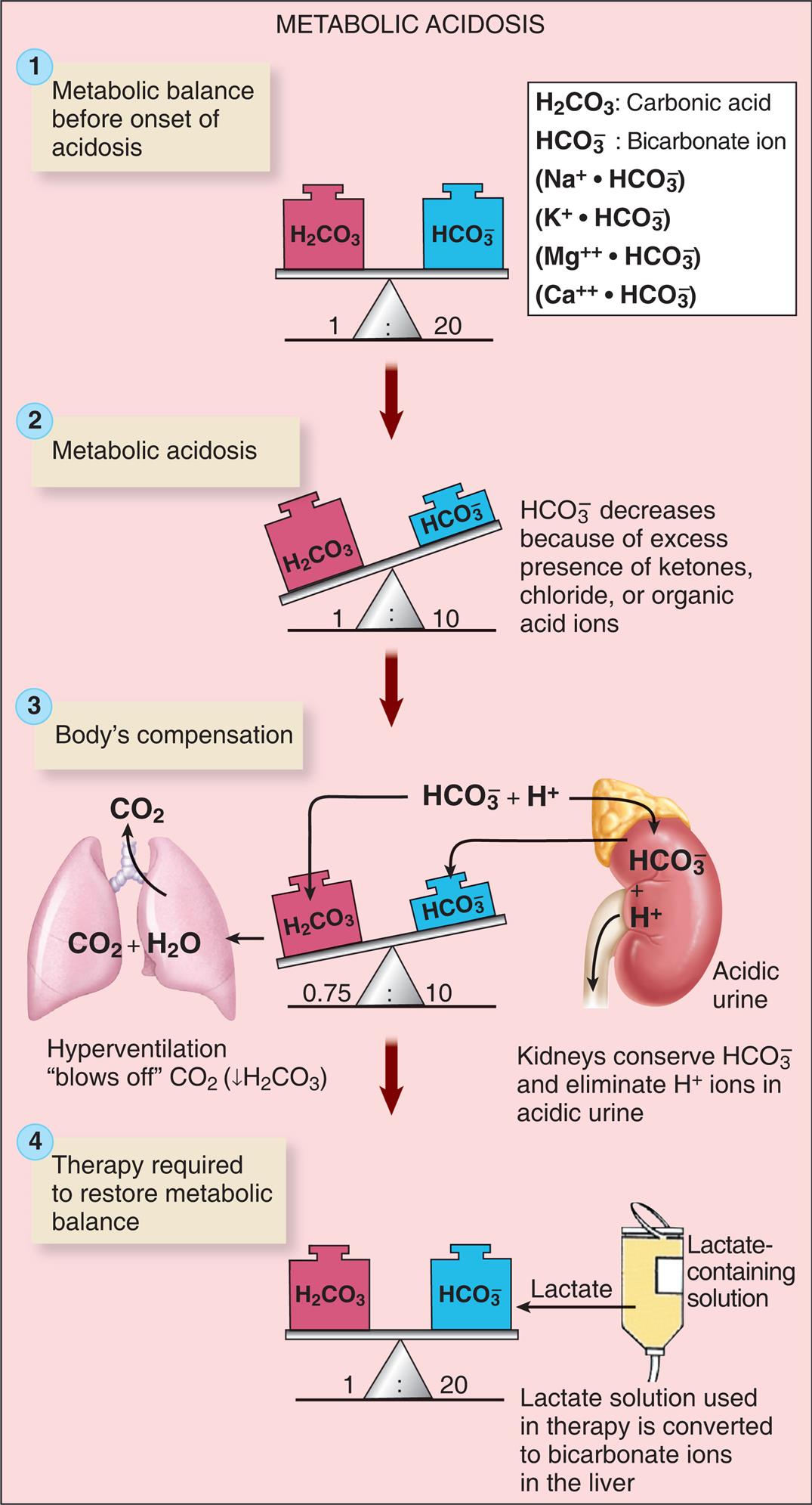 An illustrated flowchart shows the metabolic acidosis process with compensation and correction. There are four stages in the process. 1. Metabolic balance before onset of acidosis. Carbonic acid and bicarbonate ion are balanced in the ratio 1 to 20. 2. Metabolic acidosis. Carbonic acid and bicarbonate ion are unbalanced in the ratio 1 to 10. Carbonic acid decreases because of excess presence of ketones, chloride, or organic acid ions. 3. Body’s compensation. Carbonic acid and bicarbonate ion are unbalanced in the ratio 0.75 to 10. Hyperventilation blows off C O 2, decreasing H 2 C O 3. Kidneys conserve H C O 3 and eliminate H ions in acidic urine. 4. Therapy required to restore metabolic balance. Carbonic acid and bicarbonate ion are balanced in the ratio 1 to 20. Lactate-containing solution used in therapy is converted to bicarbonate ions in the liver.