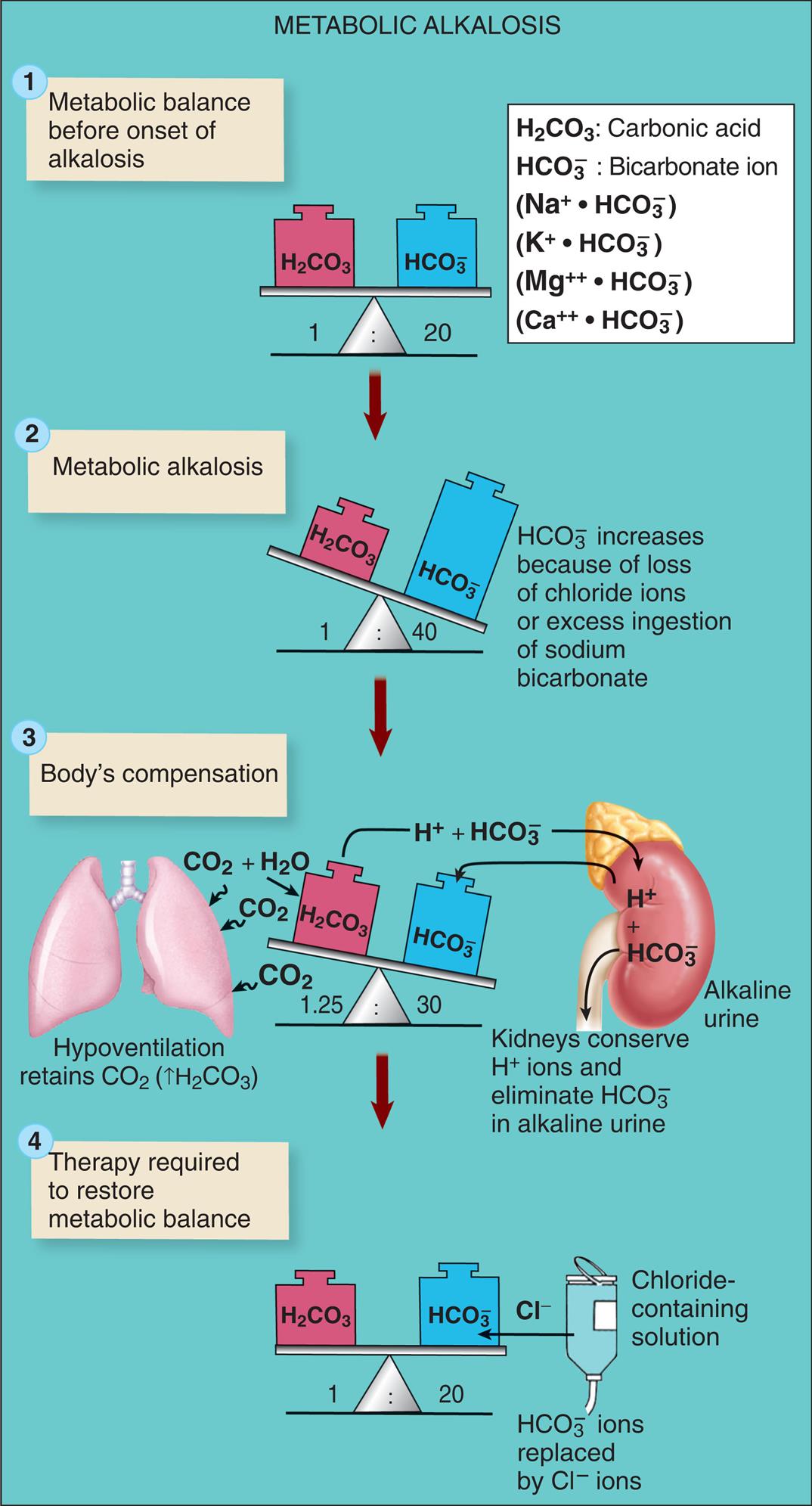 An illustrated flowchart shows hypochloremic metabolic alkalosis. There are four stages in the process. 1. Metabolic balance before onset of alkalosis. Carbonic acid and bicarbonate ion are balanced in the ratio 1 to 20. 2. Metabolic alkalosis. Carbonic acid and bicarbonate ion are unbalanced in the ratio 1 to 40. Carbonic acid increases because of loss of chloride ions or excess ingestion of sodium bicarbonate. 3. Body’s compensation. Carbonic acid and bicarbonate ion are unbalanced in the ratio 1.25 to 30. Kidneys conserve H ions and eliminate H C O 3 in alkaline urine. Hypoventilation retains C O 2 (increased H 2 C O 3). 4. Therapy required to restore metabolic balance. Carbonic acid and bicarbonate ion are balanced in the ratio 1 to 20. Chloride-containing solution used to replace H C O 3 ions with chlorine ions.