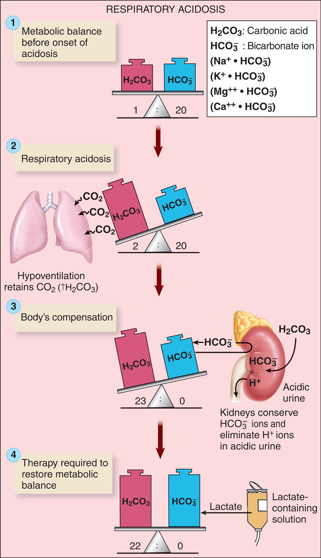 An illustrated flowchart shows the respiratory acidosis process with compensation and correction. There are four stages in the process. 1. Metabolic balance before onset of acidosis. Carbonic acid and bicarbonate ion are balanced in the ratio 1 to 20. 2. Respiratory acidosis. Carbonic acid and bicarbonate ion are unbalanced in the ratio 2 to 20. Hypoventilation retains C O 2 (increased H 2 C O 3). 3. Body’s compensation. Carbonic acid and bicarbonate ion are unbalanced in the ratio 23 to 0. Kidneys conserve H C O 3 ions and eliminate H ions in acidic urine. 4. Therapy required to restore metabolic balance. Carbonic acid and bicarbonate ion are balanced in the ratio 22 to 0. Lactate-containing solution is used in therapy.