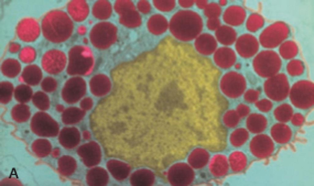 Panel A shows a colorized photomicrograph of a mast cell at the center surrounded densely by intracellular granules. Panel B shows flowchart tracking the degranulation and synthesis of a mast cell. Degranulation releases the following substances: 1. Chemotactic factors include neutrophil chemotactic factor that attracts neutrophils, and eosinophil chemotactic factor that attracts eosinophils. 2. Histamine causes vascular dilation and permeability. 3. Cytokines, for example, T N F alpha, I L 4, 5, 6, and 13, include inflammation and adaptive immunity. Synthesis releases the following substances: 1. Phospholipase A 2 includes arachidonic acid, and platelet-activating factor that causes vascular effects and platelet activation. Arachidonic acid, in turn, releases the following substances: 1. 5-lipoxygenase include leukotrienes that cause vascular dilation and permeability and bronchoconstriction, and cyclooxygenase include prostaglandins that cause vascular dilation and permeability, and pain. 2. Growth factors include endothelial cell, connective tissue, and smooth muscle proliferation.