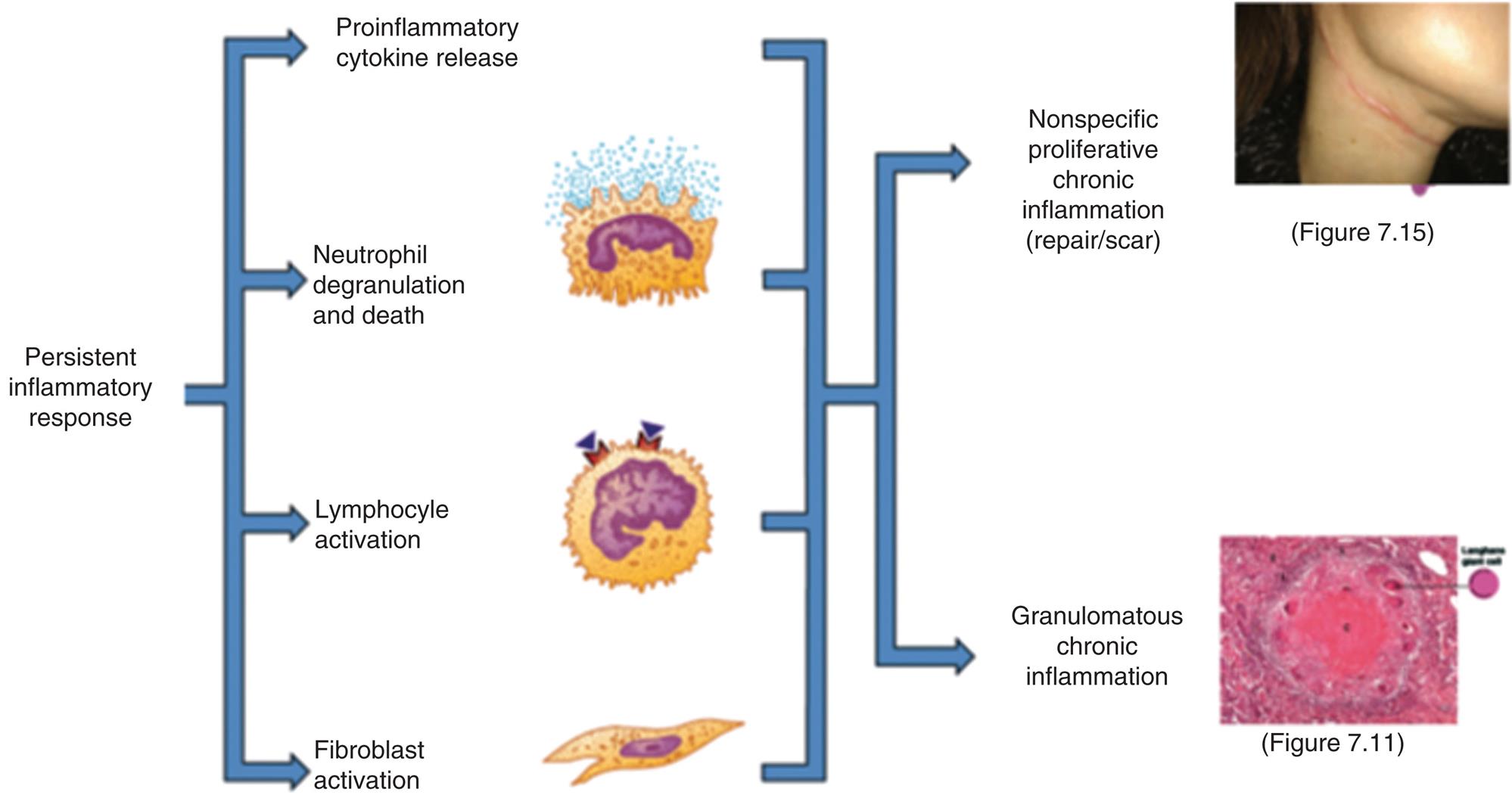 An illustration identifies the types of chronic inflammation. Persistent inflammatory responses: • Proinflammatory cytokine release. • Neutrophil degranulation and death. • Lymphocyte activation. • Fibroblast activation. All responses lead to nonspecific proliferative chronic inflammation (repair or scar) and granulomatous chronic inflammation. A closeup of a hypertrophic scar shows a thin line of raised fibrous tissue running around the upper throat of a person. A photomicrograph of cells affected by tuberculous granuloma shows a smooth central area (amorphous caseous necrosis) and some pits indicating langhans giant cells, surrounded by epithelioid macrophage cells and lymphocytes.