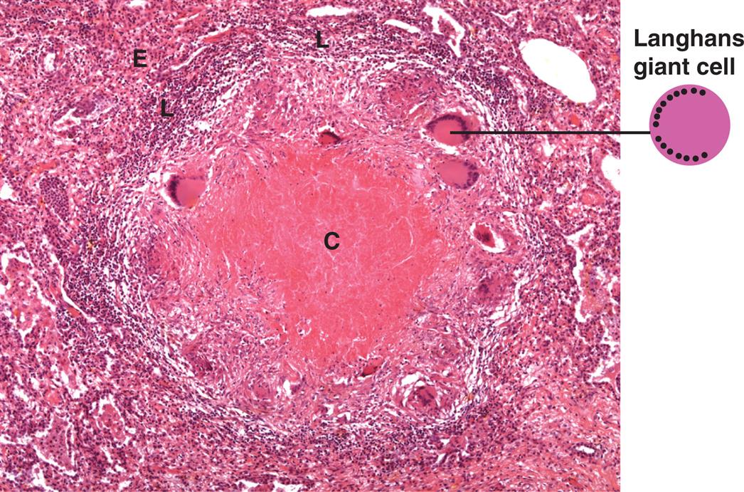 A photomicrograph of cells affected by tuberculous granuloma shows a smooth central area (amorphous caseous necrosis) and some pits indicating langhans giant cells, surrounded by epithelioid macrophage cells and lymphocytes.