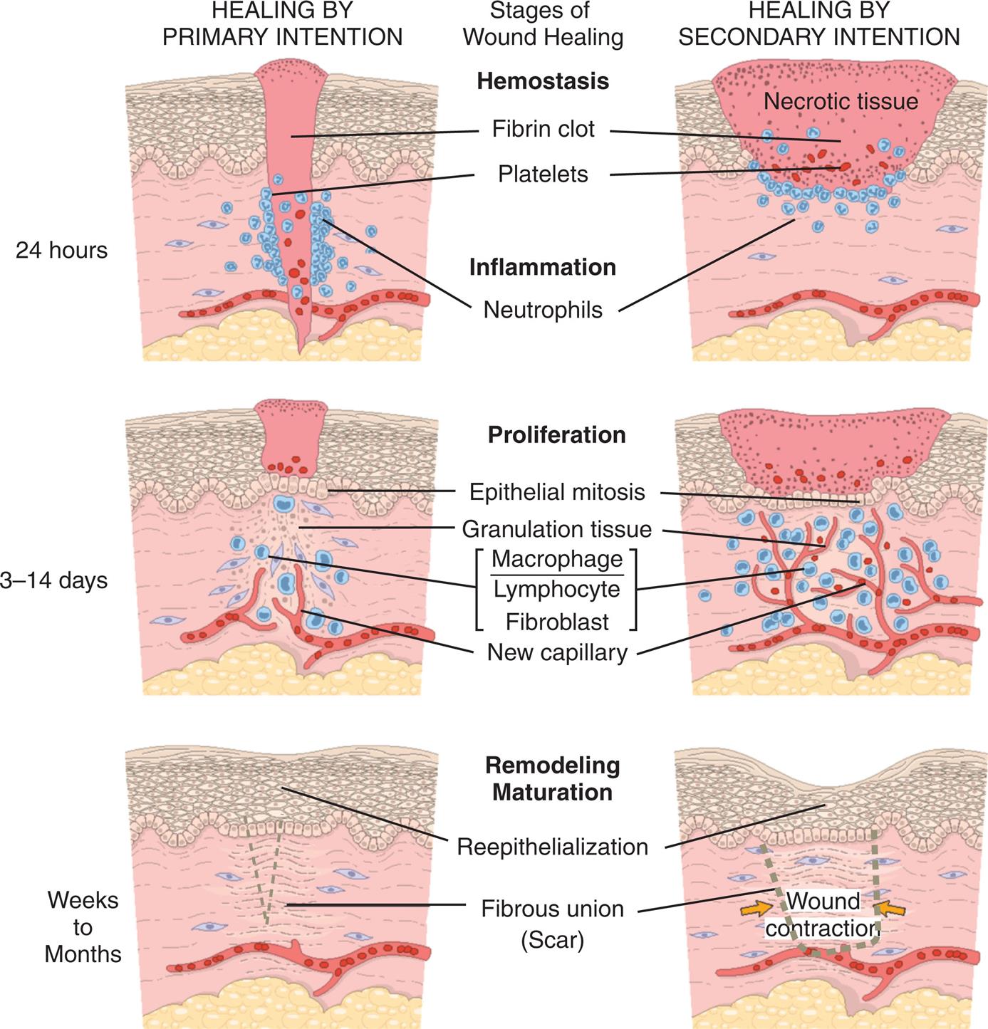 Three pairs of illustrations show wound healing by primary and secondary intention by stage. Top pair of illustrations, 24 hours. There are two stages of healing. 1, hemostasis. Platelets surround the fibrin clot. 2, Inflammation. Neutrophils bind to the site of injury in healing by primary intention and the necrotic tissue in healing by secondary intention. Middle pair of illustrations, 3 days to 14 days. There is one stage of healing, proliferation. It involves epithelial mitosis, granulation tissue, macrophage, lymphocyte, fibroblast, and new capillary. Bottom pair of illustrations, weeks to months. There is one stage of healing, remodeling maturation. It involves reepithelialization and fibrous union (scar). In healing by secondary intention, the wound contracts.