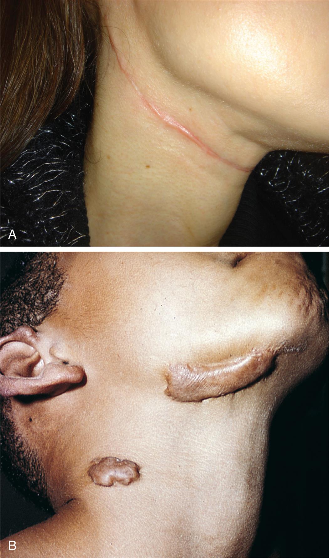Closeup A is a hypertrophic scar that shows a thin line of raised fibrous tissue running around the upper throat of a person. Closeup B is a pair of keloid scars: one under a person’s chin and the other at the base of the person’s throat. Both scars are large, raised, discolored bumps on the skin surface.