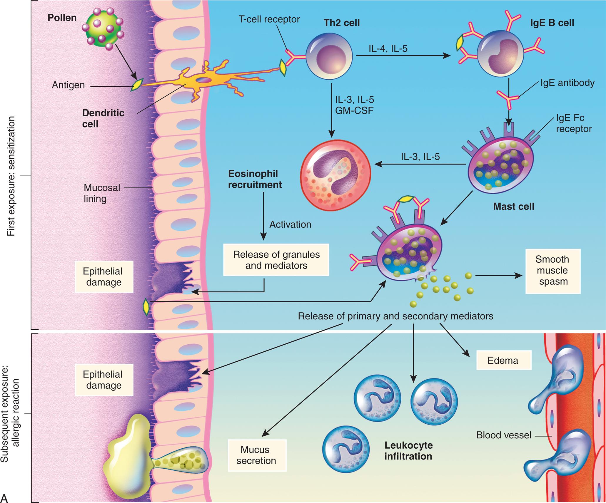 An illustration demonstrates the mechanism of type 1, immunoglobulin E (I g E)-mediated reaction. Top panel, first exposure: sensitization. The illustration shows a tissue with mucosal lining. Pollen generates antigen that a dendritic cell transports through the epithelial layer and presents to the T-cell receptor on T h 2 cell, which leads to: • I L-4 and I L-5 present the antigen to the antibodies on the I g E B cell. • I L-3, I L-5, G M-C S F generate cytokine signals. I g E antibody from the I g E B cell binds to the I g E F c receptor in the mast cell, which leads to: • I L-3 and I L-5 recruit eosinophil and activates release of granules and mediators from the site of epithelial damage. • Smooth muscle spasm, releasing primary and secondary mediators. Eosinophil recruitment activates the release of granules and mediators at the site of epithelial damage. Antigen from this site binds to the antibodies on the I g E F c receptor of the mast cell, releasing primary and secondary mediators. Bottom panel, subsequent exposure: allergic reaction. Release of primary and secondary mediators leads to: • Epithelial damage. • Mucus secretion. • Leukocyte infiltration; enters the blood vessel. • Edema." "An illustration shows the activation of mast cells. The illustration shows 2 I g E antibodies bound to antigen through variable region and to the I g E receptor through F c region, sending the signal as follows: • Degranulation. • Cytokine gene activation leads to secretion of cytokines. • Activation of phospholipase A sub 2. Degranulation generates the following granule contents (primary mediators): • Histamine. • Proteases. • Chemotactic factors (E C F, N C F). Membrane phospholipids produce arachidonic acid (secondary mediators) or P A F. Arachidonic acid can be: • Leukotrienes: B sub 4, C sub 4, and D sub 4. • Prostaglandin: D sub 2.