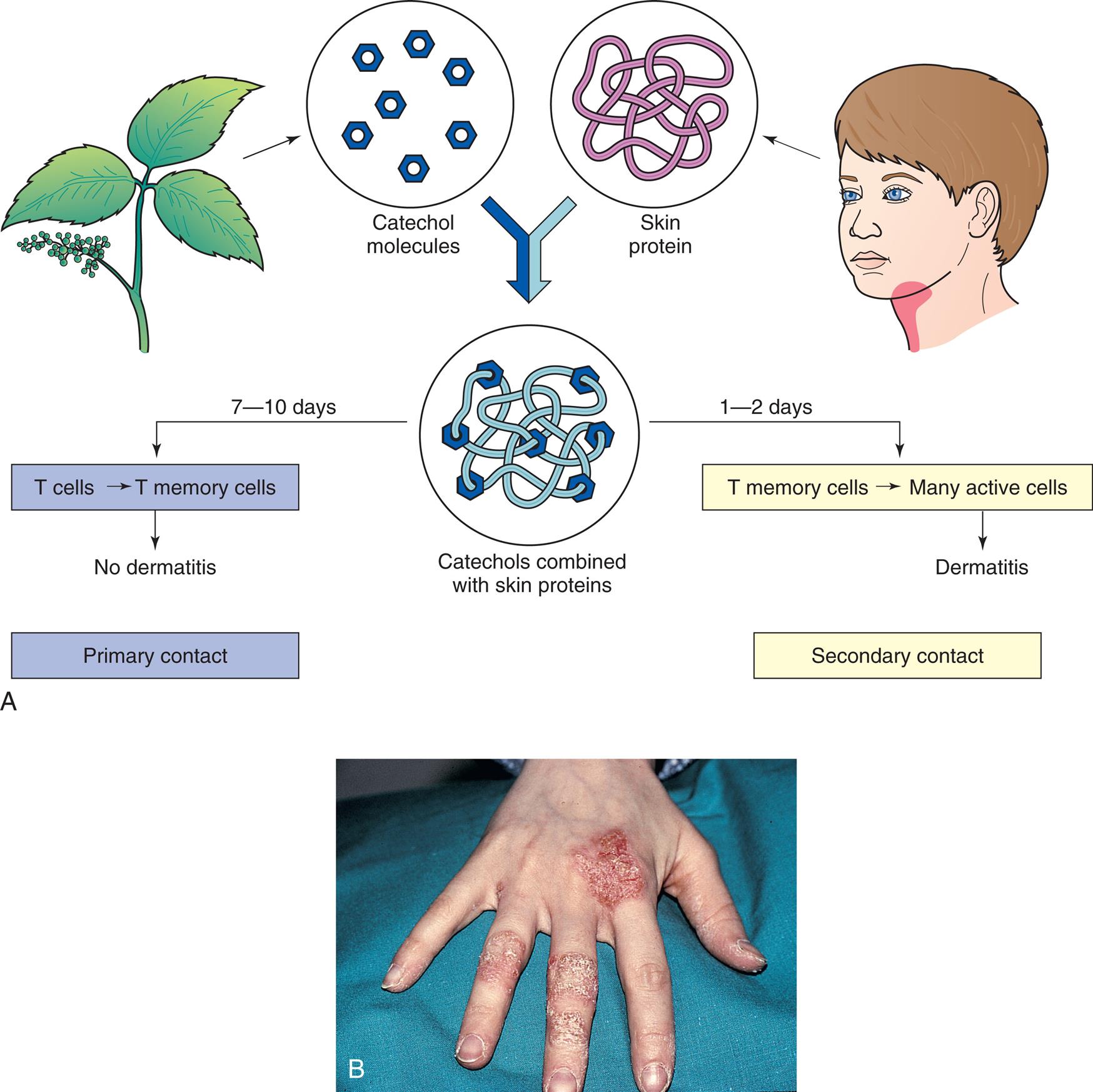 Top panel, A, is an illustrated flowchart showing the development of type 4 hypersensitivity to poison ivy. Catechol molecules from poison ivy combines with the skin proteins on humans. • 7 to 10 days: T cells to T memory cells, no dermatitis. Primary contact. • 1 to 2 days: T memory cells to many active cells, dermatitis. Secondary contact. Bottom panel, B, is a closeup of a hand affected by dermatitis. The skin appears dry and cracked on the fingers and on the surface below the index finger.