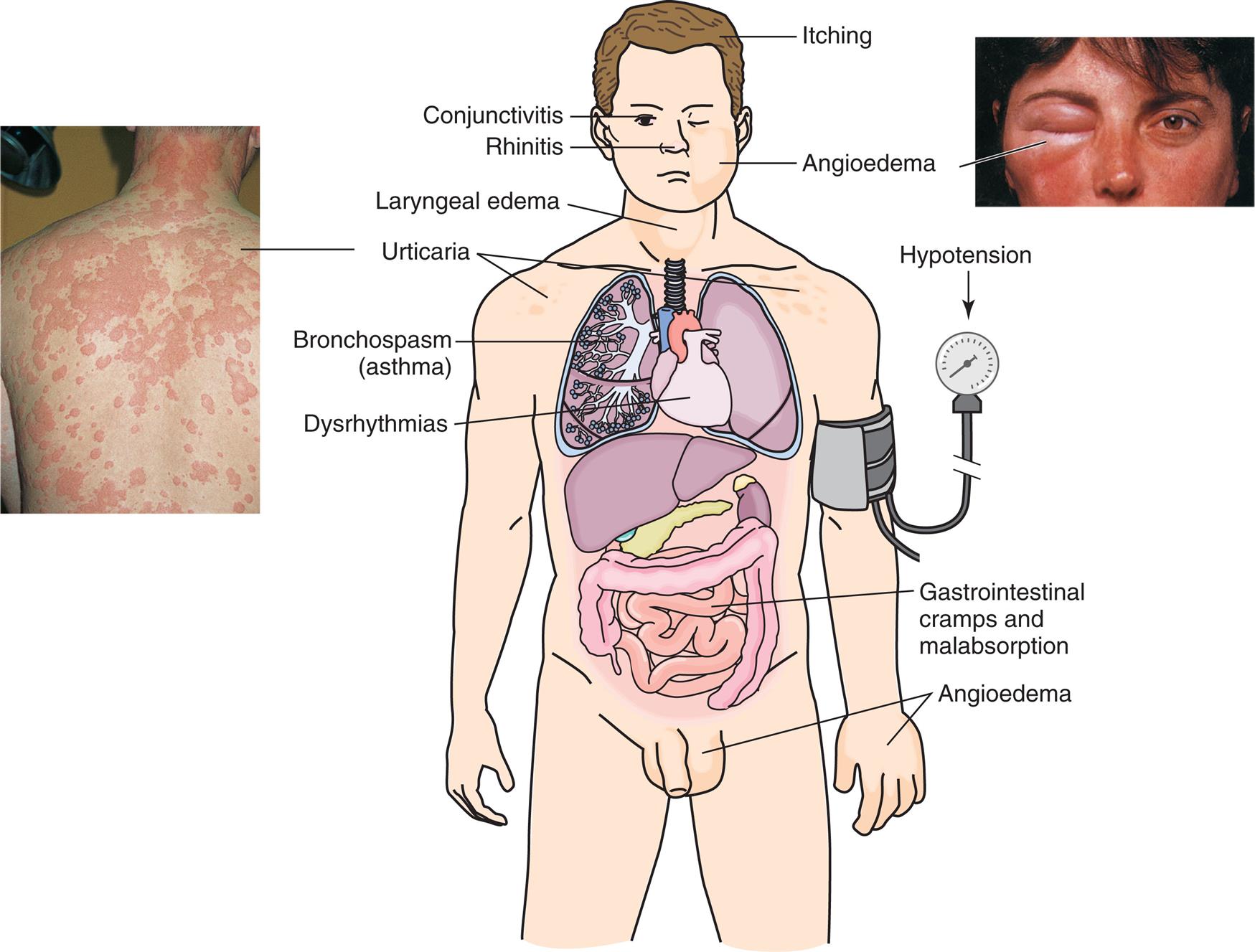 An illustration shows the anterior view of a human, with the internal organs highlighted. The following conditions are highlighted on the illustration: • Head: itching. • Eye: conjunctivitis. • Nose: rhinitis. • Cheek: angioedema (an accompanying closeup shows a person’s eye swollen shut). • Neck: laryngeal edema. • Shoulders: urticaria (an accompanying closeup shows a person’s shoulders and back, covered in welts). • Lungs: bronchospasm (asthma). • Heart: dysrhythmias. • Upper arm (attached with a blood pressure gauge): hypotension. • Intestines: gastrointestinal cramps and malabsorption. • Hands and genitalia: angioedema.