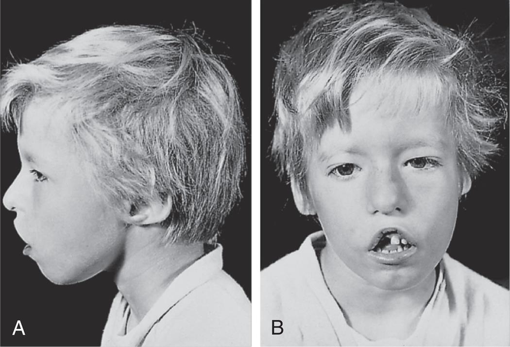 Two photos, A and B, show the left-side profile and front profile of a child with DiGeorge syndrome. The child has hooded eyes, long face, and a cleft palate.