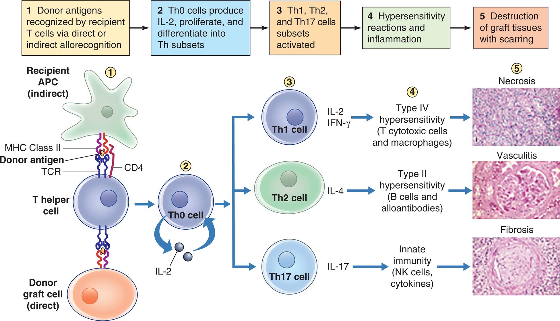 An illustration flowchart demonstrates acute graft rejection. There are five stages of rejection. 1. Donor antigens recognized by recipient T cells via direct or indirect allorecognition. Recipient A P C (indirect) and donor graft cell (direct) bind to the T helper cell through M H C class 2, donor antigen, T C R, and C D 4. 2. T h 0 cells produce I L-2, proliferate, and differentiate into T h subsets. 3. T h 1, T h2, and T h 17 cells subsets activated. 4. Hypersensitivity reactions and inflammation. 5. Destruction of graft tissue with scarring. The result of activation of the different cells are as follows: • T h 1 cell secretes I L-2, I F N-gamma. Type 4 hypersensitivity (T cytotoxic cells and macrophages) leads to necrosis. An accompanying photomicrograph shows dead cells. • T h 2 cell secretes I L-4. Type 2 hypersensitivity (B cells and alloantibodies) leads to vasculitis. An accompanying photomicrograph shows inflamed blood vessels. • T h 17 cell secretes I L-17. Innate immunity (N K cells, cytokines) leads to fibrosis. An accompanying photomicrograph shows a network of fibrous connective tissue.