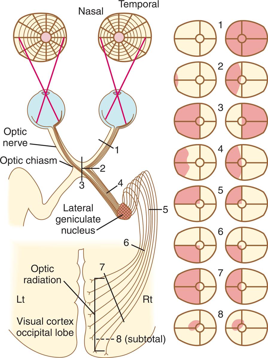 Two illustrations depict the visual field deficits produced by lesions at various points along the visual pathway. The illustration on the left depicts the visual pathway and the lesions at various points numbered from 1 through 8. The labels on the visual pathways are optic nerve, optic chiasm, lateral geniculate nucleus, optic radiation, and visual cortex occipital lobe. The illustration on the right depicts the eight visual pathway lesions.