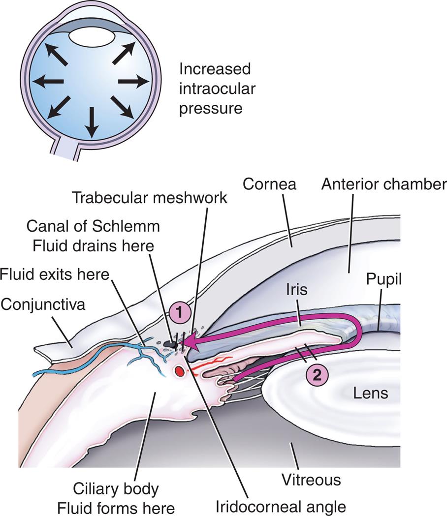 The illustration on the top depicts the increased intraocular pressure. Illustration on the bottom depicts the section of the outer eye with the structures labeled: conjunctiva where fluid exists here, the canal of Schlemm where fluid drains here, trabecular meshwork, cornea, anterior chamber, ciliary body where fluid forms, vitreous, iridocorneal angle, iris, pupils, and lens. An arrow mark at trabecular meshwork indicates open-angle glaucoma and at the iris indicates closed-angle glaucoma.