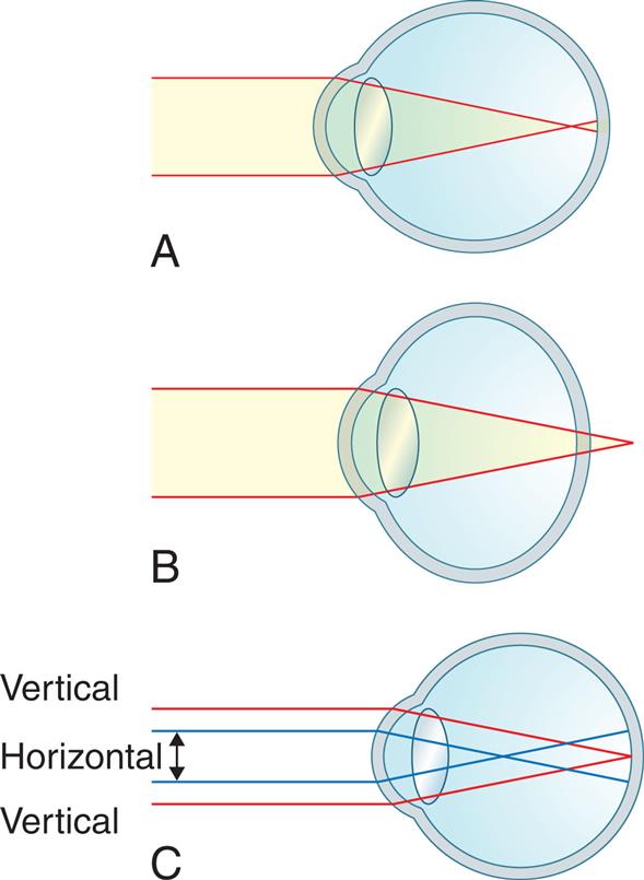 Three illustrations A through C depict the three types of refraction alterations. Illustration A shows parallel rays of light from a distant object focused in front of the retina. Illustration B shows the parallel rays of light from a distant object focused behind the retina. Illustration C shows the horizontal and vertical rays focused in front and on the retina respectively.