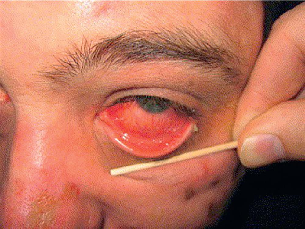 Close shot of a patient’s left eyelid being pulled down exposing the reddish eye.