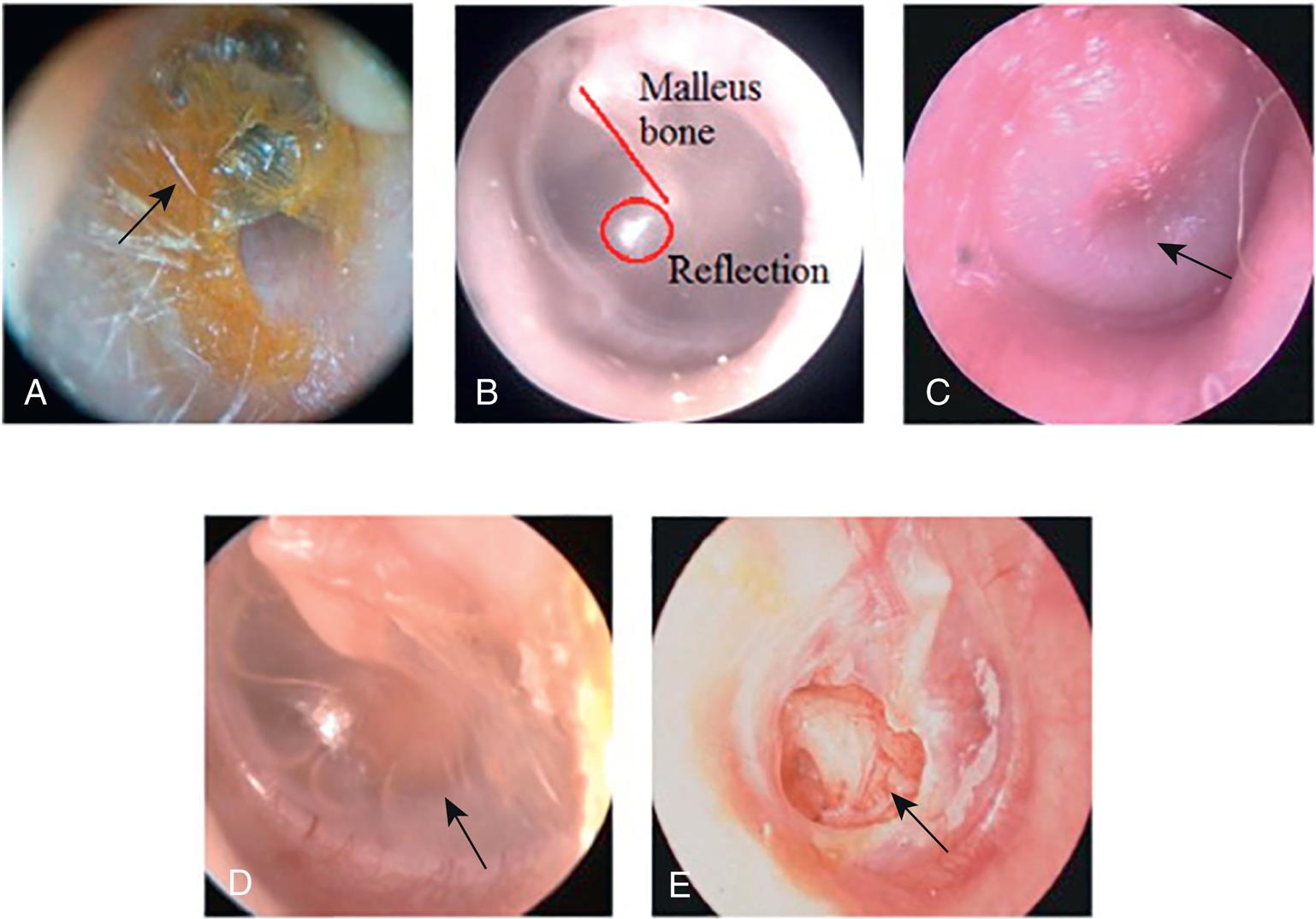 Photomicrography A shows the external ear canal and an arrow indicates the presence of obstructing wax. Photomicrography B shows the external ear canal with a light reflection indicated by a circle and a line indicating the malleus bone. Photomicrography C shows the external ear canal and an arrow mark indicates the bulged tympanic membrane. Photomicrography D shows the external ear canal and an arrow mark indicates the presence of fluid in the middle ear with a retracted tympanic membrane. Photomicrography E shows the external ear canal and an arrow mark indicates the perforated tympanic membrane.