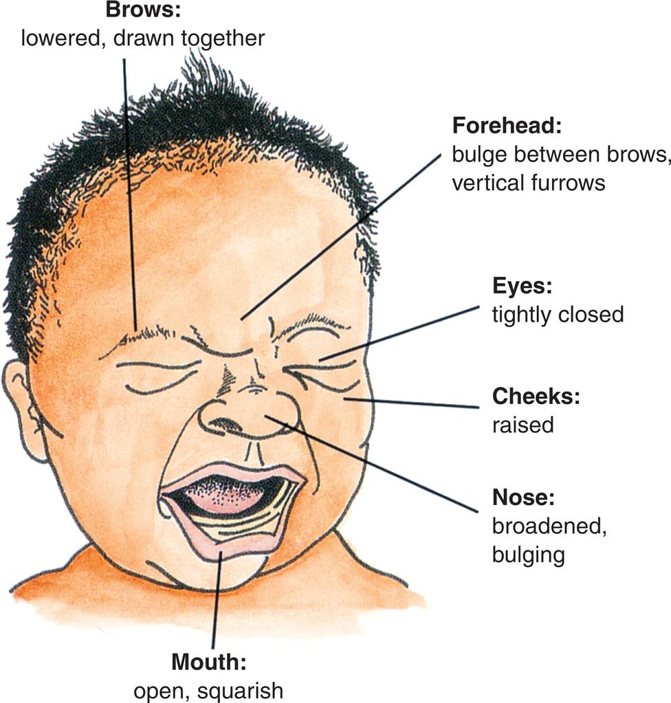An illustration of the anterior profile of a crying infant depicts the facial expression of pain labeled as follows. Brows: Lowered, drawn together. Forehead: bulge between brows, vertical furrows; eyes: Tightly closed; cheeks: raised; Nose: broadened bulging.
