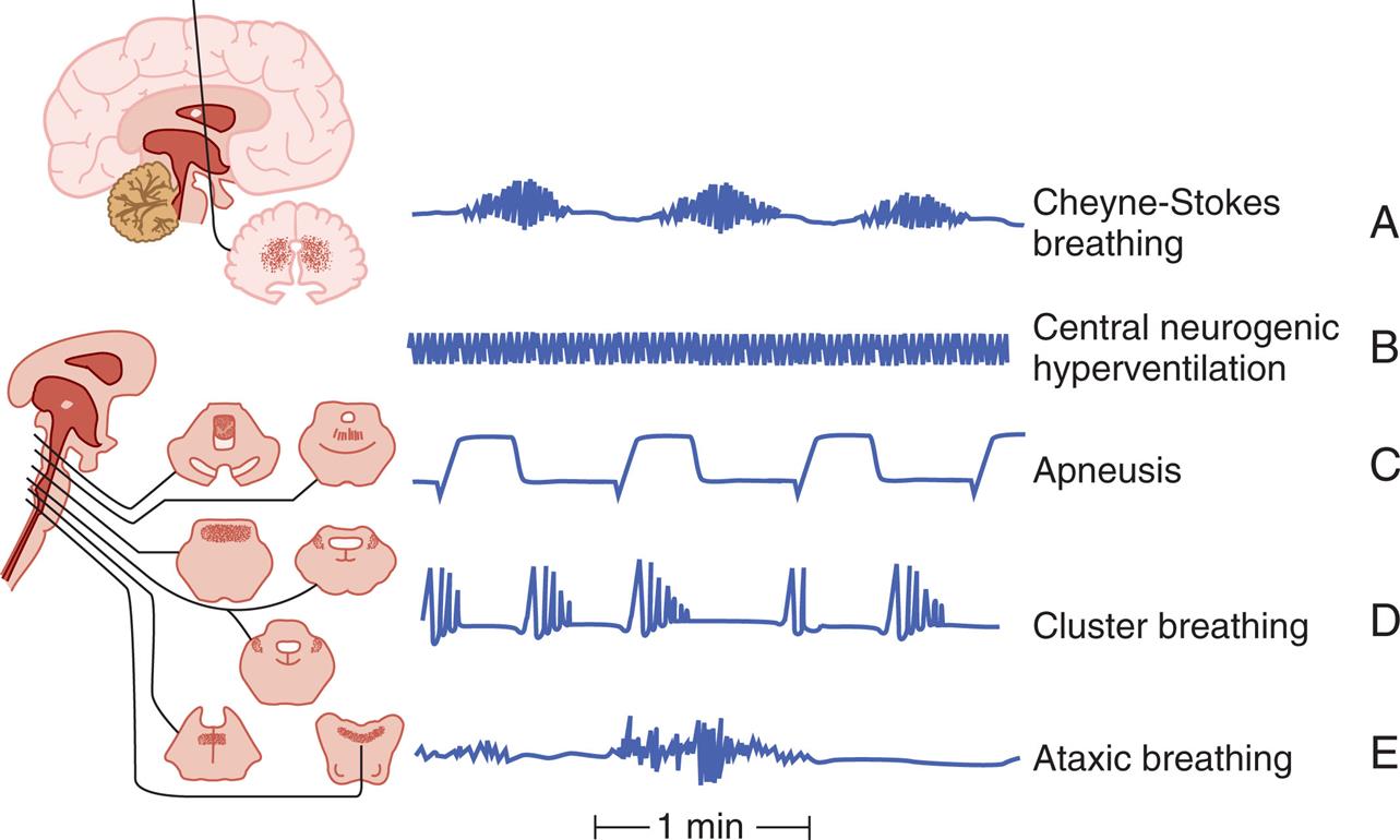 An illustration depicts the abnormal respiratory patterns associated with pathologic lesions at various levels of the brain. Tracings by chest-abdomen pneumograph, inspiration reads up. A; Cheyne-stokes respiration. B; Central neurogenic hyperventilation. C; Apneusis. D; Cluster breathing. E; Ataxic breathing.