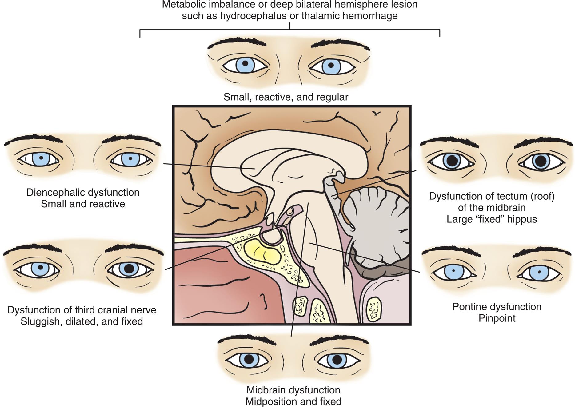 A series of illustrations shows the appearance of pupils at different levels of consciousness with reference to the brain stem. The six appearances are as follows. • Metabolic imbalance or deep bilateral hemisphere lesion such as hydrocephalus or thalamic hemorrhage. The pupils are small, receptive, and regular. • Dysfunction of tectum (roof) of the midbrain; large, fixed hippus. • Pontine dysfunction; pinpoint. • Midbrain dysfunctional; midposition and fixed. • Dysfunction of third cranial nerve sluggish, dilated, and fixed. • Diencephalic dysfunction; small and reactive.