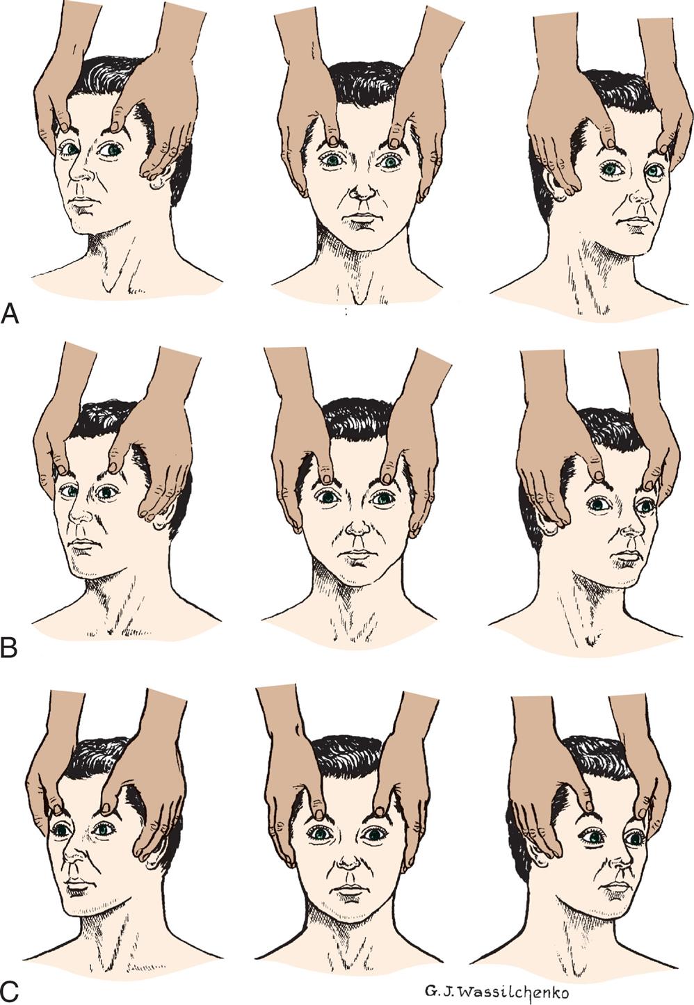 Three sets of illustrations demonstrate the test for oculocephalic reflect response. Each set shows a pair of hands positioned on the sides of a person’s face with the thumbs pulling upward on the eyebrows. In each set, the illustration on the left shows the head turned to the right, the illustration in the middle shows the head facing forward, and the illustration on the right shows the head turned toward the left. Top panel, A. The positions of the pupils are as follows. On the left, the pupils look to the left together. In the middle, the pupils look straight ahead together. On the right, the pupils look to the right together. Middle panel, B. The positions of the pupils are as follows. On the left, the pupils are converged toward the nose. In the middle, the pupils look straight ahead together. On the right, the right pupil looks to the right, while the pupil on the left look straight ahead. Bottom panel, C. The positions of the pupils are as follows. On the left, in the middle, and on the right, the pupils look absently straight ahead.