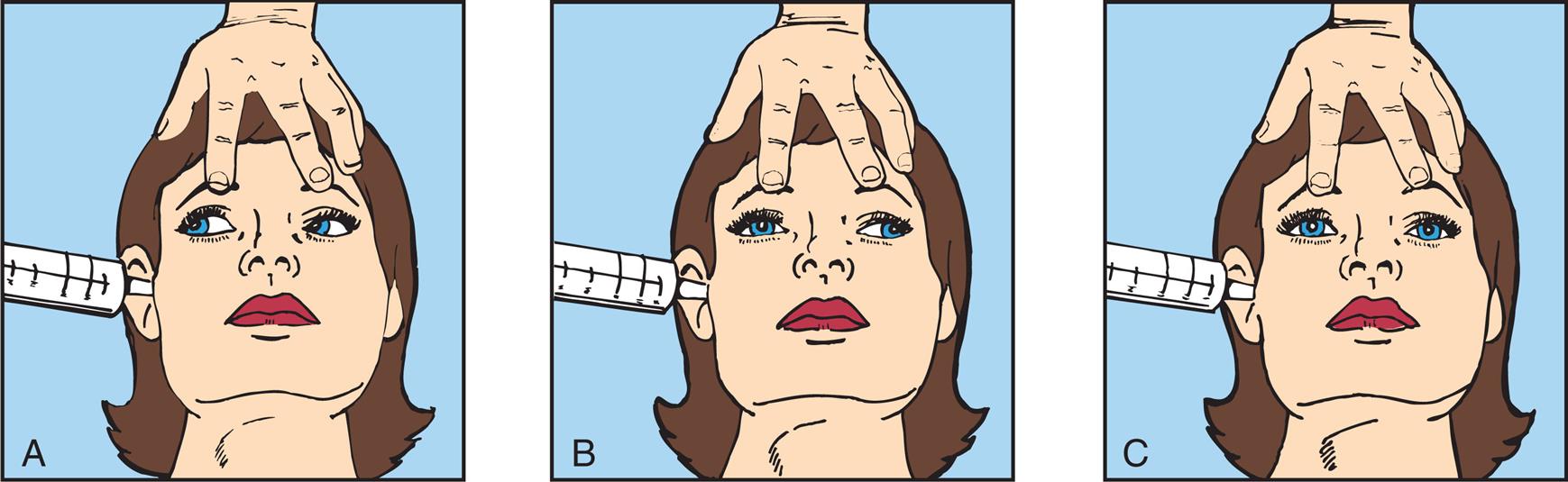 Three illustrations, A, B, and C, demonstrate the test of oculovestibular reflex. Each illustration shows a person's head in supine position, a hand pressing down on the head, and a syringe pressed into the right ear. Left panel, A. The pupils look together on the right, toward the syringe. Middle panel, B. The right pupil looks straight ahead, while the left pupil looks to the right. Right panel, C. Both pupils look straight ahead together.