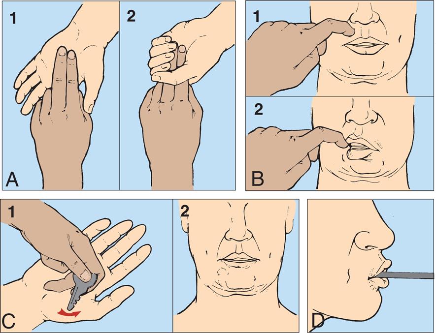 Four pairs of illustrations, A, B, C, and D, demonstrate pathologic reflexes. Top-left panel, A. The illustration on the left, 1, shows two hands. The index and the middle fingers of one hand are placed on the open palm of the other hand. The illustration on the right, 2, shows the palm closed around the two fingers on the other hand. Top-right panel, B. The illustration on the left, 1, shows an index finger pressing above the upper lip. The illustration on the right, 2, shows the lips turned toward the finger, sucking. Bottom-left panel, C. The illustration on the left, 1, shows a hand holding a key and stroking near the thumb of an open palm. The illustration on the right, 2, shows the twitching chin of a person. Bottom-right panel, D. The illustration shows the right lateral profile of the lower jaw of a person. The lips are pursed around a pencil-like object.