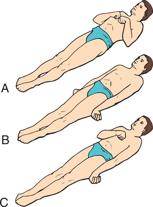 Three illustrations of a person in supine position demonstrate the decorticate and decerebrate responses. Top panel, A. The illustration shows the person’s arms flexed with the hands together on the chest. The feet are pointed forward. Middle panel, B. The illustration shows the person’s arms on their sides, the hands flexed outward, and the feet pointing forward. Bottom panel, C. The illustration shows one arm of the person on the side, the other arm flexed with the wrist on the chest, and the feet pointing forward.