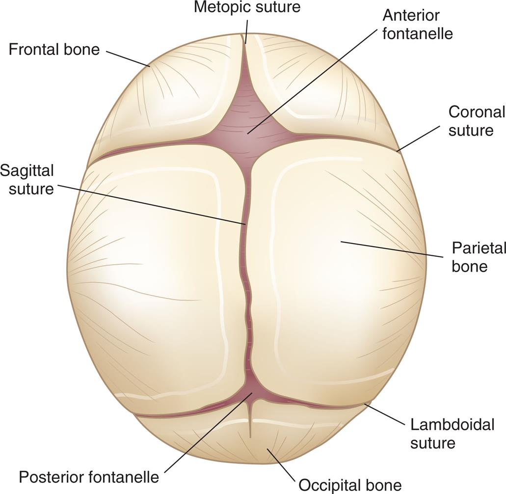 A coronal view of the skull shows and labels the following parts, clockwise from the top: metopic suture, anterior fontanelle, coronal suture, parietal bone, lambdoidal suture, occipital bone, posterior fontanelle, sagittal suture, and frontal lobe.