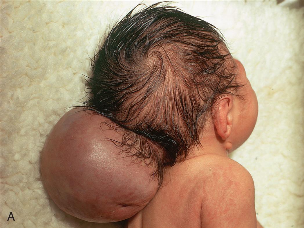 Closeup A shows an infant on the side with a large herniation, the size of the infant’s head, at the base of the head. Two pairs of accompanying illustrations show lateral and cross-sectional views of the spine. One pair shows meningocele and the other pair shows myelomeningocele. Closeup B shows an infant lying on its stomach with the legs curled toward to the abdomen. There is a large herniation on the lower back. Two pairs of accompanying illustrations show lateral and cross-sectional views of a normal spine and a spine affected by spina bifidia. Some of the vertebrae are missing in the spine with spina bifida.