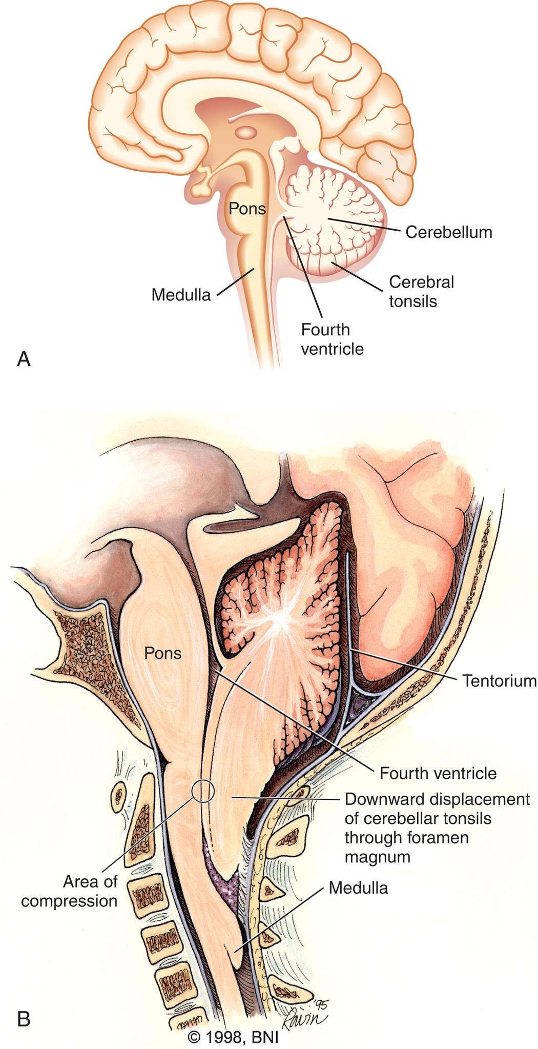Illustration A is a left lateral view of the brain with the following parts labeled: cerebellum, cerebral tonsils, fourth ventricle, pons, and medulla. Illustration B is a left lateral view of the base of the brain with the following parts labeled: tentorium, fourth ventricle, pons, downward displacement of cerebellar tonsils through foramen magnum, area of compression, and medulla.