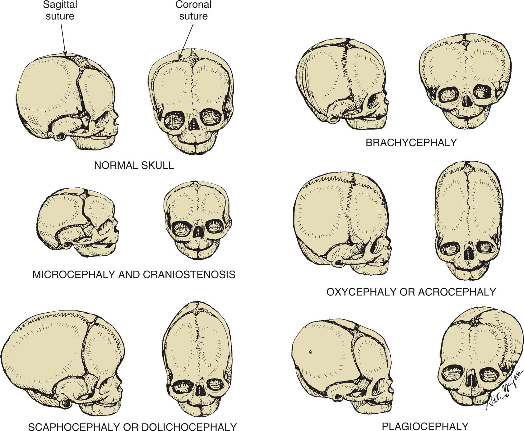 Six pairs of illustrations of skulls show normal and abnormal head configurations. Each pair shows the right lateral view and the anterior view of the skull. Top left, normal skull. The sagittal suture is identified in the lateral view. The coronal suture is identified in the anterior view. Top right, brachycephaly. The sagittal suture in the lateral view is shrunken. The coronal suture in the anterior view is almost non-existent. The head is unusually large. Middle left, microcephaly and craniostenosis. The skulls are smaller than normal. The sagittal suture in the lateral view is shrunken. The coronal suture in the anterior view is minimal. Middle right, oxycephaly or acrocephaly. The sagittal suture in the lateral view and the coronal suture are almost non-existent. The head is almost twice as long as normal. Bottom left, scaphocephaly or dolichocephaly. The skulls are larger and narrower. The sagittal suture and the coronal suture are minimal. Bottom right, plagiocephaly. The skulls are misshapen. The left and the right side are disproportional. The sagittal suture is present. The coronal suture is only partially present.