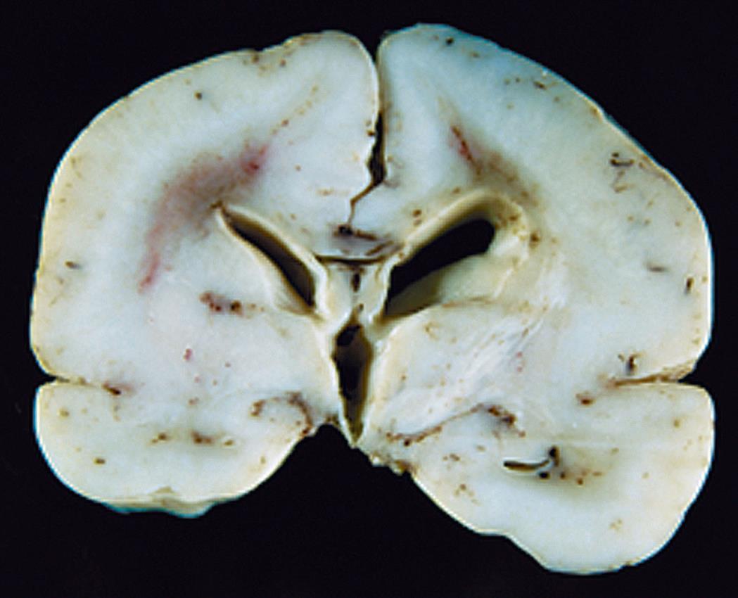 A closeup of a vertebra with lissencephaly. The cortex is almost smooth without any convolutions.