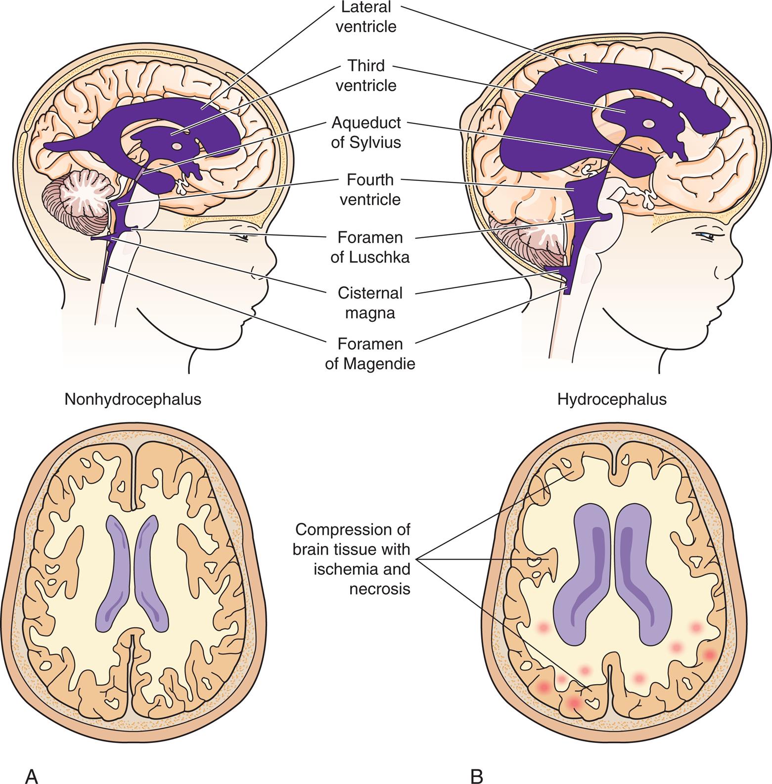 Illustration A shows the right lateral view of a child’s head and a superior view of the brain, both with nonhydrocephalus. Illustration B shows the right lateral view of a child’s head and a superior view of the brain, both with hydrocephalus. The structures in the hydrocephalus are different from those in the nonhydrocephalus in the following ways. • Lateral ventricle covers most of the brain. • Third ventricle is almost twice as large. • Aqueduct of Sylvius is thinner. • Fourth ventricle is about thrice as large. • Foramen of Luschka is bigger. • Cisternal magna is bigger. • Foramen of Magendie is shorter. • Compression of brain tissue with ischemia and necrosis. Closeup C shows the right lateral profile of an infant with hydrocephalus. The infant’s head is abnormally large. Closeup D shows the front profile of an infant with hydrocephalus. The infant’s head is abnormally large.