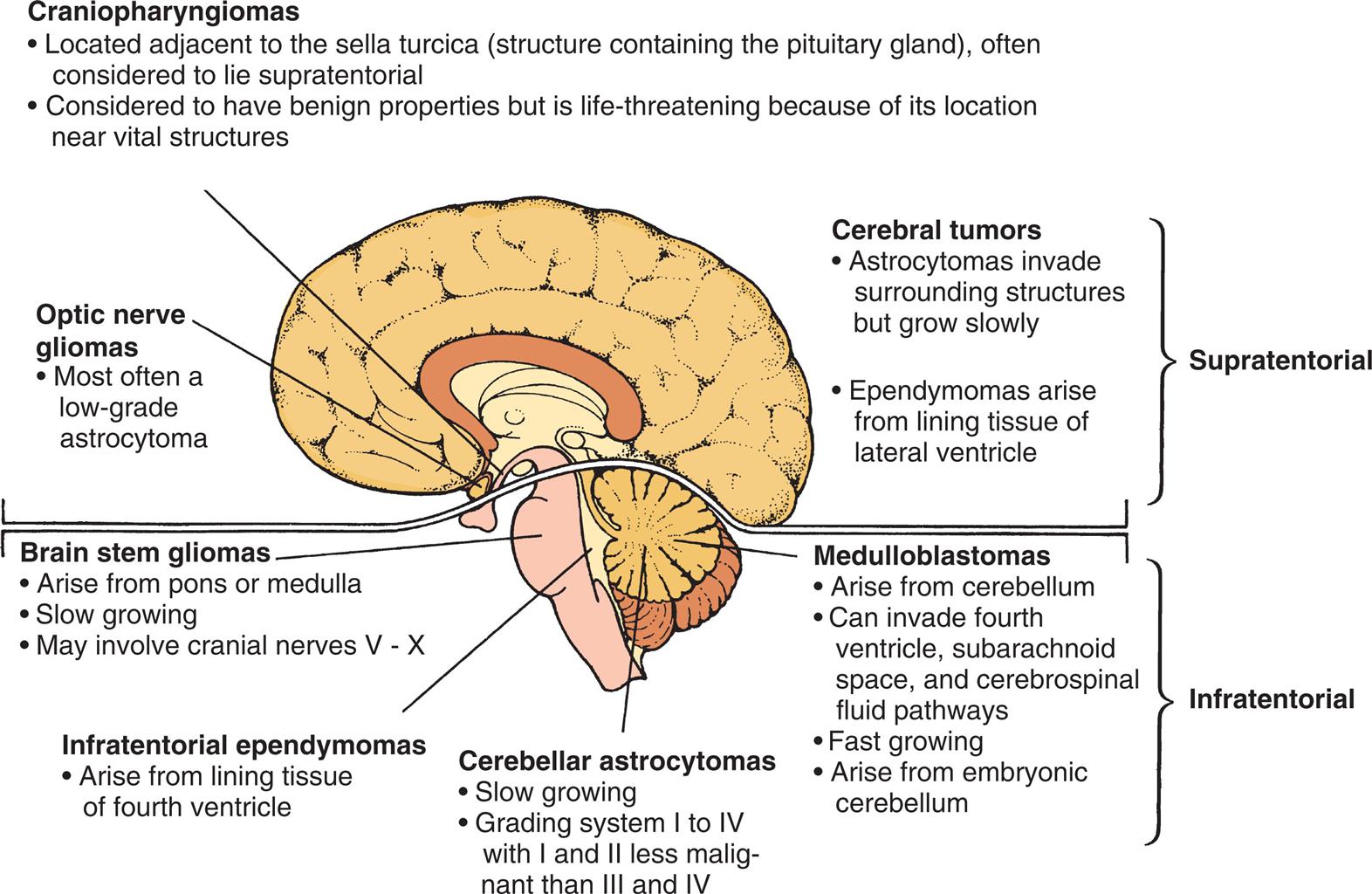An illustration of the left lateral view of a child’s brain identifies the location of brain tumors. The data from the illustration are as follows. Craniopharyngiomas. • Located adjacent to the Sella turcica (structure containing the pituitary gland), often considered to lie supratentorial. • Considered to have benign properties but is life threatening because of its location near vital structures. Optic nerve gliomas. • Most often a low-grade astrocytoma. Cerebral tumors (supratentorial). • Astrocytomas invade surrounding structures but grow slowly. • Ependymomas arise from lining tissue of lateral ventricle. Brain stem gliomas. • Arise from pons or medulla. • Slow growing. • May involve cranial nerves V to X. Medulloblastomas (infratentorial). • Arise from cerebellum. • Can invade fourth ventricle, subarachnoid space, and cerebrospinal fluid pathways. • Fast growing. • Arise from embryonic cerebellum. Infratentorial ependymomas. • Arise from lining tissue of fourth ventricle. Cerebellar Astrocytomas. • Slow growing. • Grading system 1 to 4 with 1 and 2 less malignant than 3 and 4.