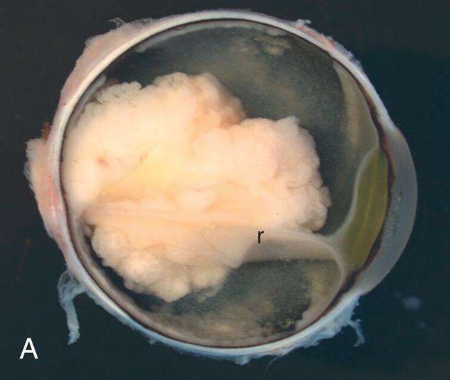 Closeup A shows a cloud of white mass in the lateral view of the vitreous body of the human eye. Closeup B shows an infant’s wide-set eyes with a tumor (cloud of white mass) in the left eye.