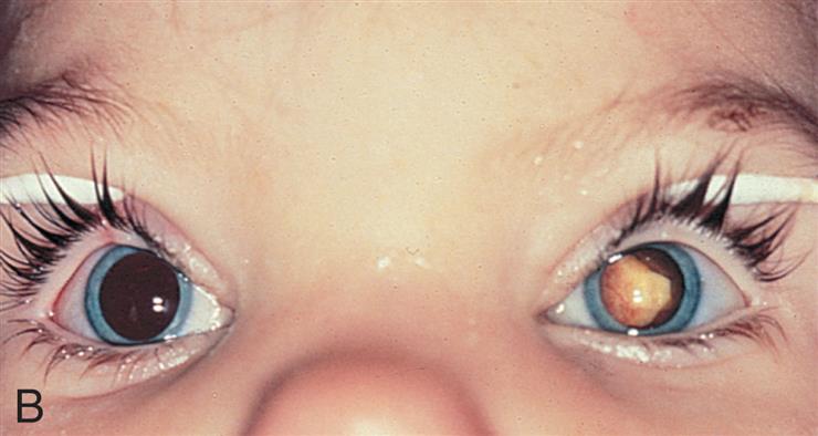 Closeup A shows a cloud of white mass in the lateral view of the vitreous body of the human eye. Closeup B shows an infant’s wide-set eyes with a tumor (cloud of white mass) in the left eye.
