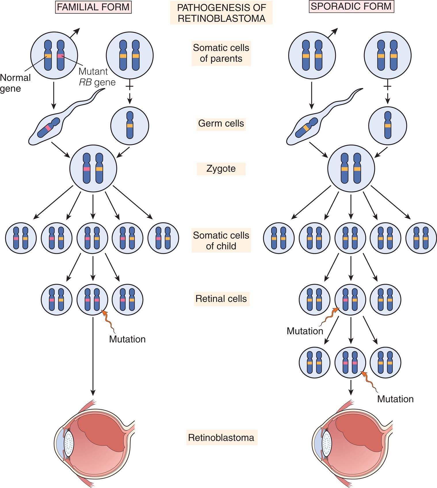 Two sets of illustrations show mutations leading to retinoblastoma development. Left panel, familial form. Somatic cells of parents show a pair of chromosomes each. Male cell contains 1 chromosome containing normal gene and 1 containing mutant gene. Mutant gene is passed into the zygote, multiplying into pairs, where each pair has one normal gene and one mutated gene. Mutation of the somatic cells of the child result in a pair of two mutated genes, leading to retinoblastoma. Right panel, sporadic form. Somatic cells of parents are both normal, that form a normal zygote, that multiply into normal somatic cells of the child. Mutation in one pair of cells leads to one mutated gene and one normal gene. Additional mutation leads to a cell with two mutated genes, leading to retinoblastoma.