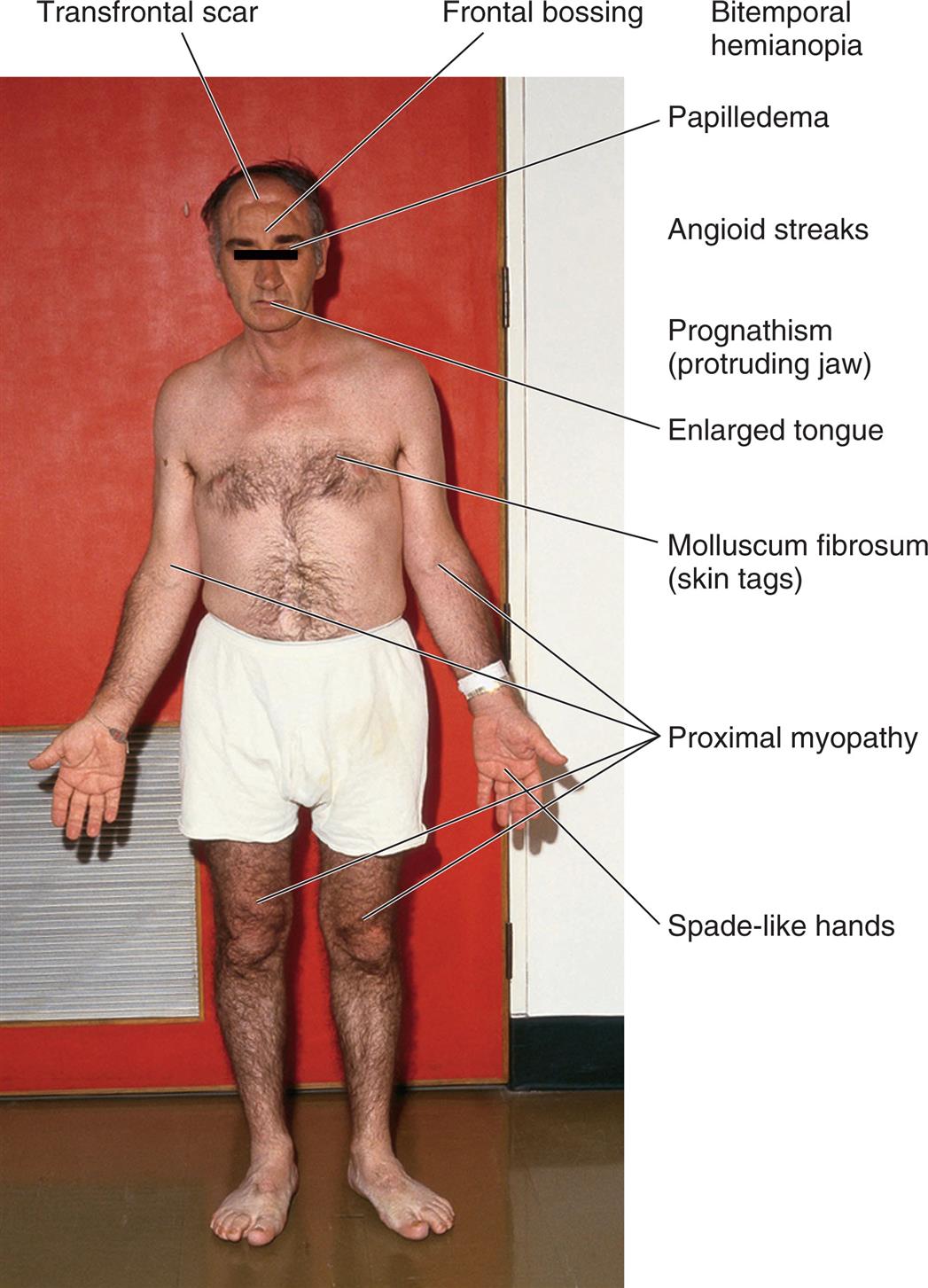 A photo of the anterior profile of a person with acromegaly shows and labels the different conditions on the body, from the top to the bottom: transfrontal scar, frontal bossing, bitemporal hemianopia, papilledema, angioid streaks, prognathism (protruding jaw), enlarged tongue, molluscum fibrosum (skin tags), proximal myopathy, and spade-like hands.