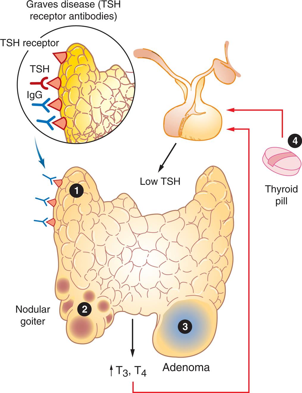 An illustration of the thyroid highlights the following common causes of hyperthyroidism. 1. Graves disease (T S H receptor antibodies). T S H receptors attract T S H and I g G. 2. Nodular goiter. The illustration shows multiple fluid-filled lumps on the thyroid. 3. Adenoma. The illustration shows a large tumor on the thyroid. 4. Thyroid pill. The illustration shows that the ingestion of the pill results in a low T S H, leading to increased T 3 and T 4, which provides a feedback loop.