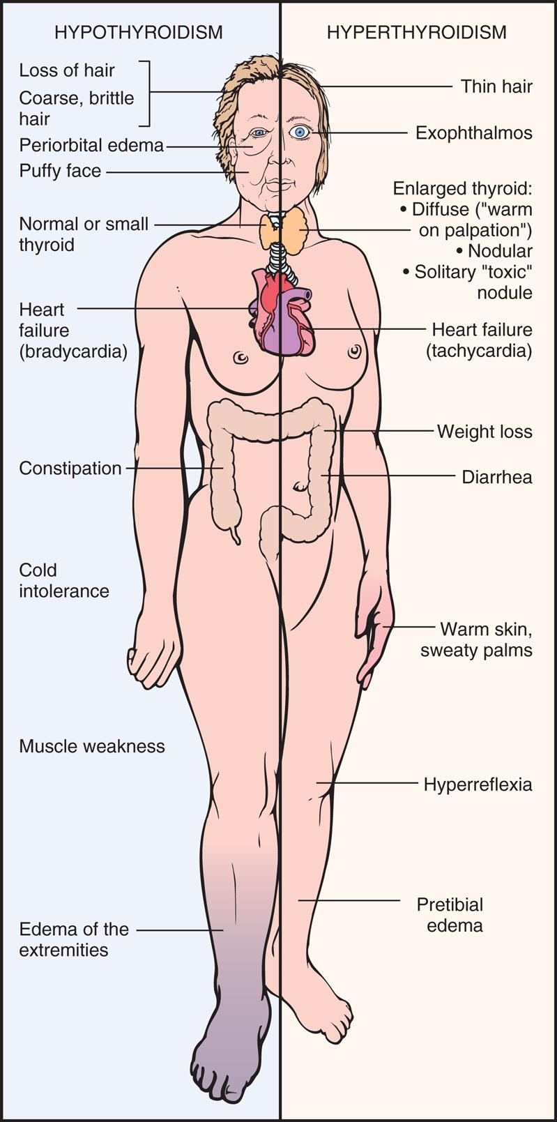 An illustration of the anterior view of a person highlights the manifestations for hypothyroidism and hyperthyroidism. The manifestations for hypothyroidism, identified from the top to the bottom, are as follows. • Loss of hair or coarse, brittle hair. • Periorbital edema. • Puffy face. • Normal or small thyroid. • Heart failure (bradycardia). • Constipation. • Cold intolerance. • Muscle weakness. • Edema of the extremities. The manifestations for hyperthyroidism, identified from the top to the bottom, are as follows. • Thin hair. • Exophthalmos. • Enlarged thyroid: diffuse (warm on palpation), nodular, solitary toxic nodule. • Heart failure (tachycardia). • Weight loss. • Diarrhea. • Warm, skin, sweaty palms. • Hyperreflexia. • Pretibial edema.
