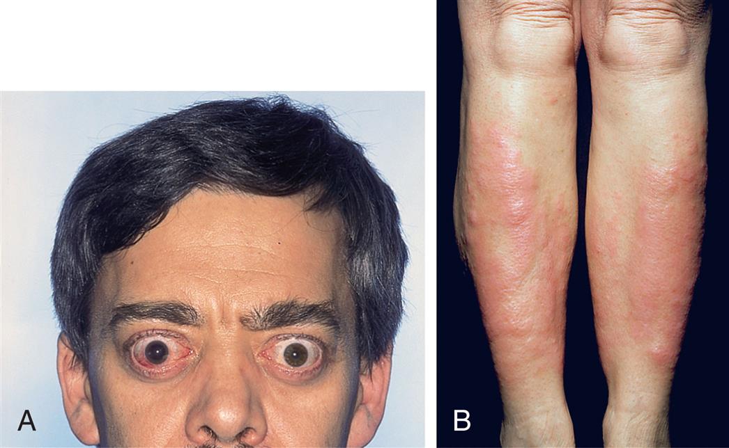 Closeup A shows the bulging eyes of a person with exophthalmos. Closeup B shows the swollen lumps on the legs of a person with Graves disease.